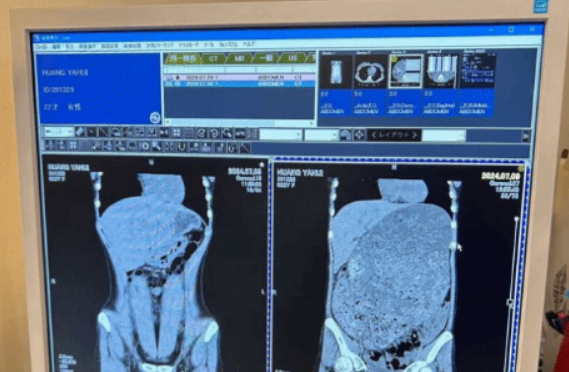 Competitive Eater’s Pre/Post-Meal CT Scan Revealed: Viral Images Shock Internet